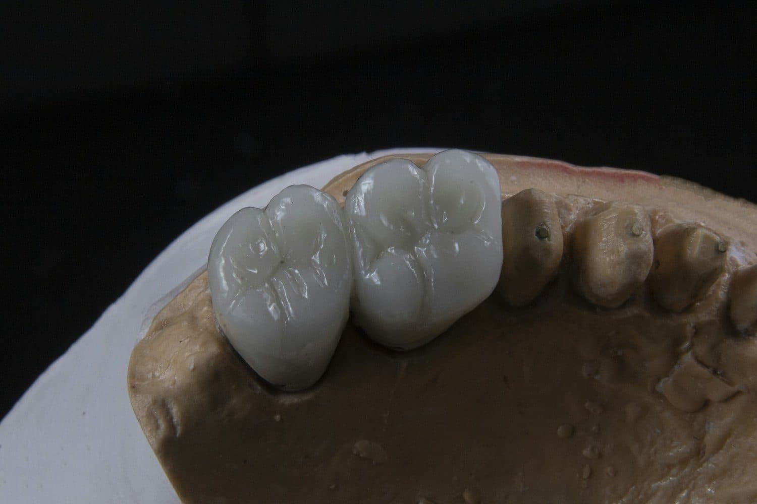 Composite White Fillings at Carlton Dental, Downtown Toronto