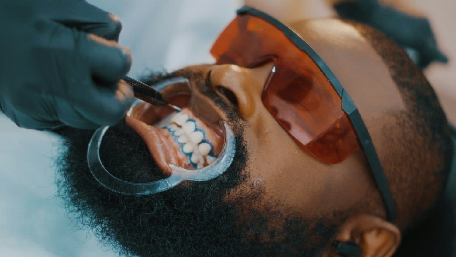Teeth Whitening at Carlton Dental, Downtown Toronto: What to Expect on Visit
